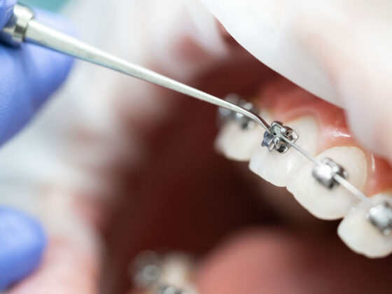 Aparat-ortodontic-probleme-aliniere-dinti