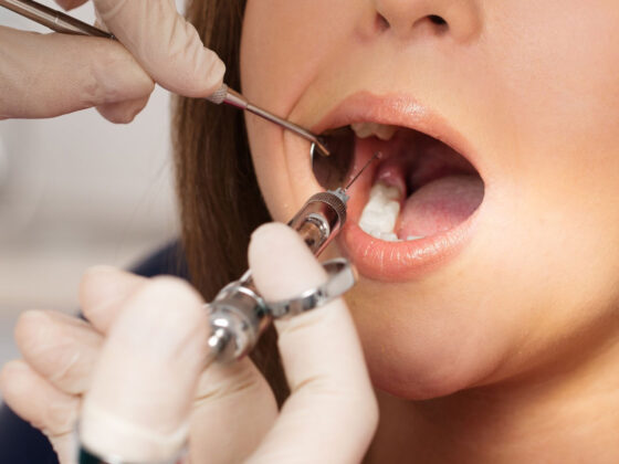 Incizia-abcesului-dentar-sub-anestezie