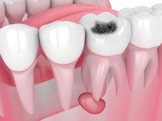 chist-oral-tratament