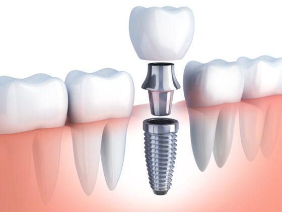 implant-dentar-ce-este