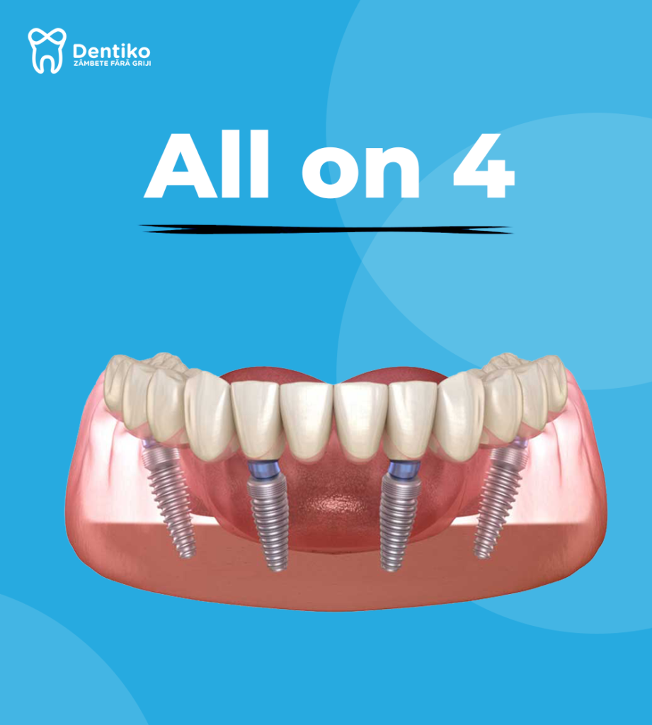 dentiko, dinti ficsi in 24 ore